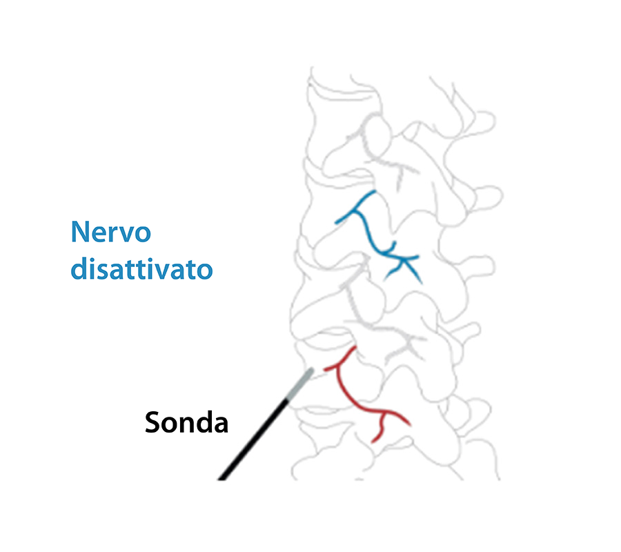 Illustrazione di come viene disattivato il nervo