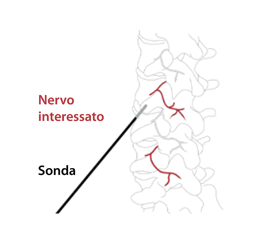 Illustrazione di come viene individuato il nervo